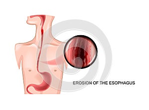Erosion of the esophagus