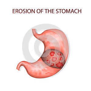 Erosion of the stomach