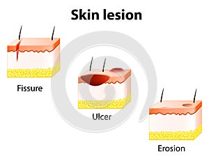 Erosion, Ulcer and Fissure photo