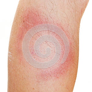 Erythema Migrans rash.