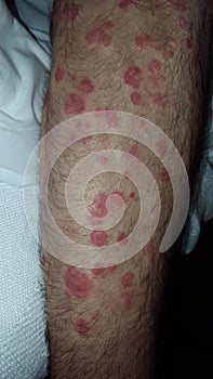 Erythema multiforme annular erythematous targetoid skin lesions photo