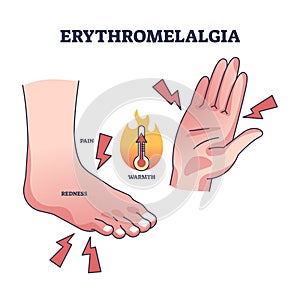 Erythromelalgia syndrome caused redness, pain and warmth outline diagram