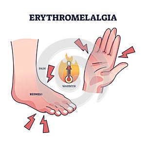 Erythromelalgia syndrome caused redness, pain and warmth outline diagram photo