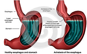 Esophageal achalasia 3d medical  illustration on white background