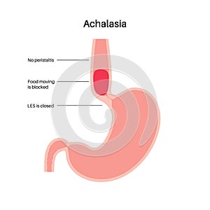 Esophageal achalasia disease