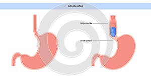 Esophageal achalasia disease