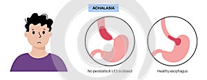 Esophageal achalasia disease