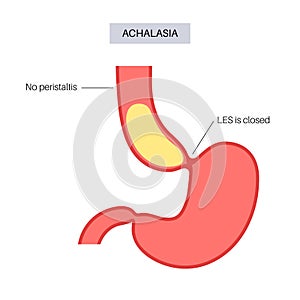 Esophageal achalasia disease