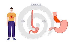 Esophageal achalasia disease