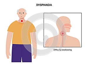 Esophageal achalasia disease