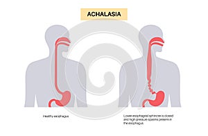 Esophageal achalasia disease