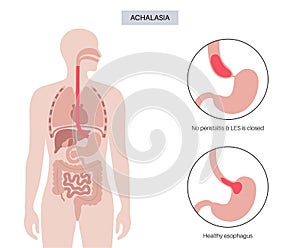 Esophageal achalasia disease