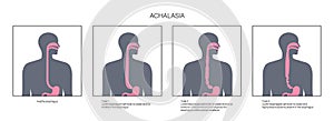 Esophageal achalasia disease