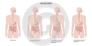 Esophageal achalasia disease