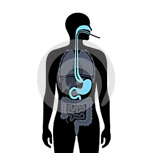 Esophageal achalasia disease photo