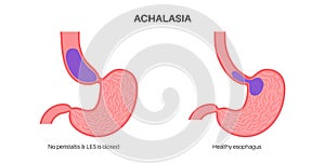 Esophageal achalasia disease photo