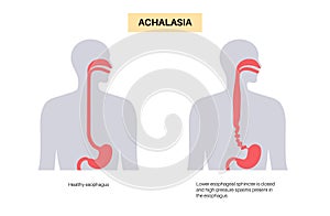 Esophageal achalasia disease photo