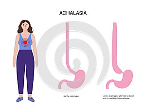 Esophageal achalasia disease photo