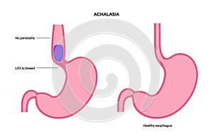 Esophageal achalasia disease photo