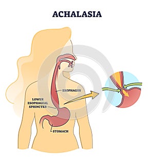 Esophageal achalasia disease with lower sphincter failure outline diagram photo