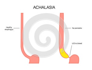 Esophageal achalasia disease photo