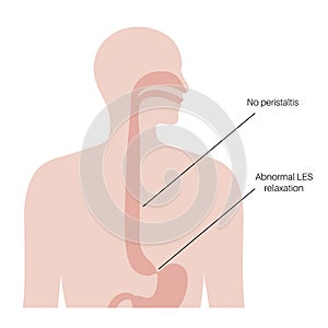 Esophageal achalasia disease photo