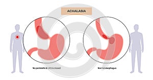 Esophageal achalasia disease photo