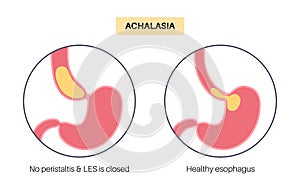 Esophageal achalasia disease photo