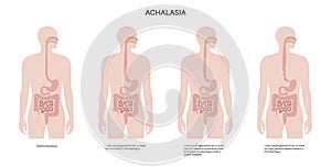 Esophageal achalasia disease photo