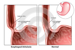 Esophageal achalasia, often called simple achalasia.