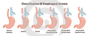 Esophageal atresia types set. Congenital medical condition of trachea