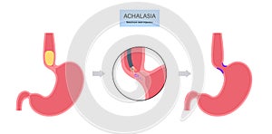 esophageal botulinum toxin injection