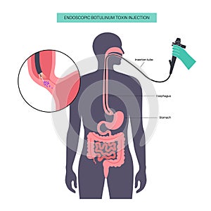 esophageal botulinum toxin injection