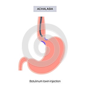 esophageal botulinum toxin injection