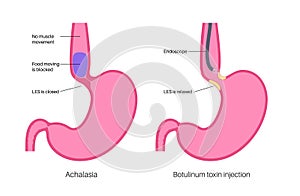 esophageal botulinum toxin injection