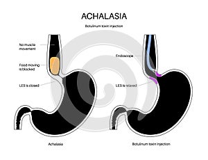 esophageal botulinum toxin injection