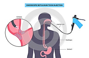 esophageal botulinum toxin injection