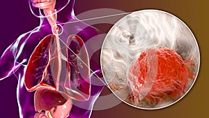 Esophageal cancer, illustration