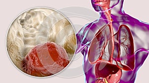 Esophageal cancer, illustration