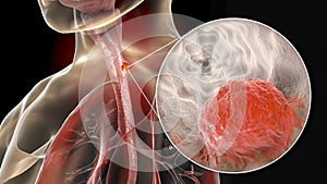 Esophageal cancer, illustration