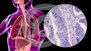 Esophageal cancer, illustration and micrograph