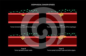 esophageal cancer stages