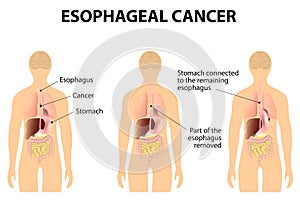 Esophageal Cancer photo