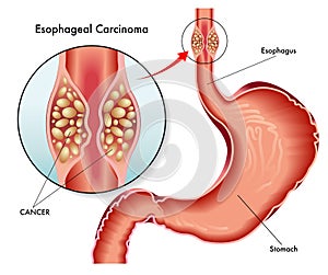 Esophageal carcinoma