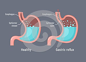Esophageal gastric reflux acid indigestion. Gastrointestial stomach heartburn gerd gastric reflux photo