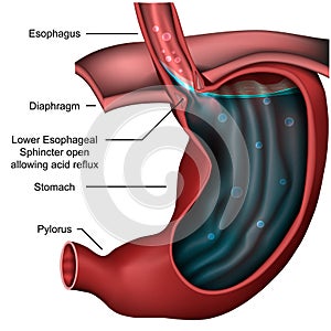 Esophageal sphincter anatomy Reflux 3d medical  illustration photo