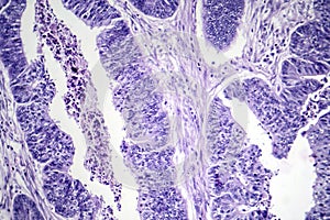 Esophageal squamous cell carcinoma, light micrograph