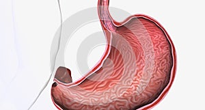 Esophageal varices are extremely dilated submucosal veins in the lower third of the esophagus photo