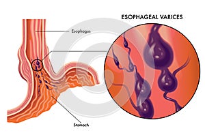 Esophageal varices medical illustration photo