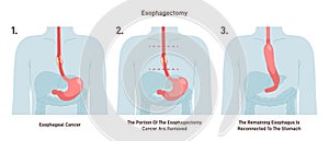 Esophagectomy. Partial excision of the esophagus. Surgical procedure